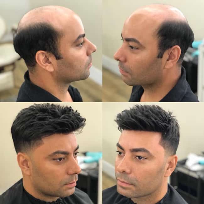 Non Surgical Hair Replacement 